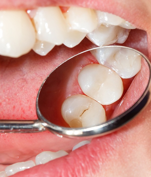 White Dental Fillings | Sarcee Dental | NW Calgary | General and Family Dentist
