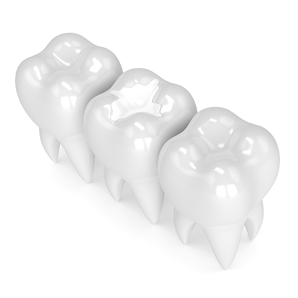 White Fillings | Sarcee Dental | NW Calgary | General and Family Dentist